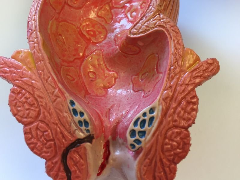 Cirurgia minimamente invasiva hemorroida Porto Alegre