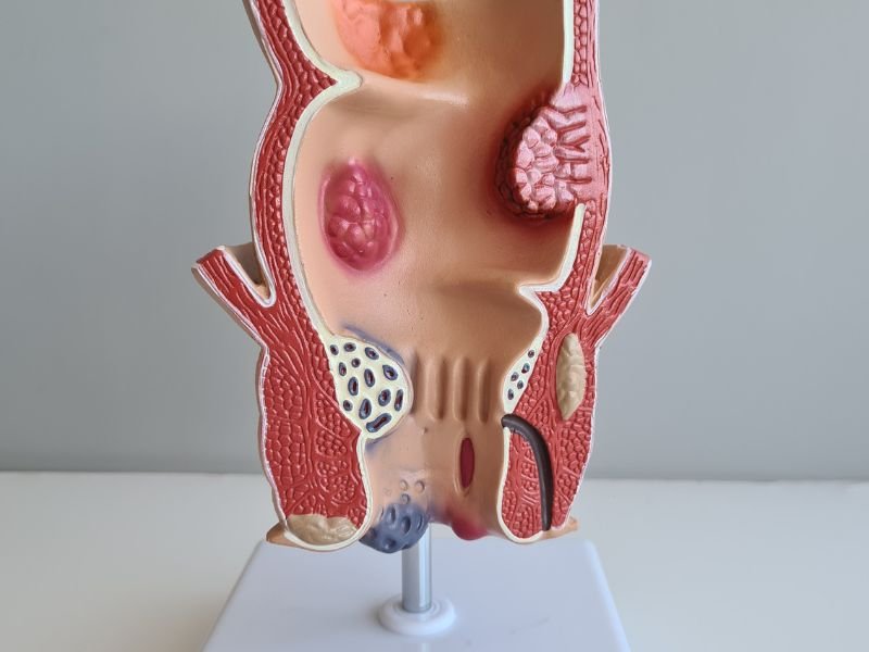 Especialista em Hemorroidas Porto Alegre