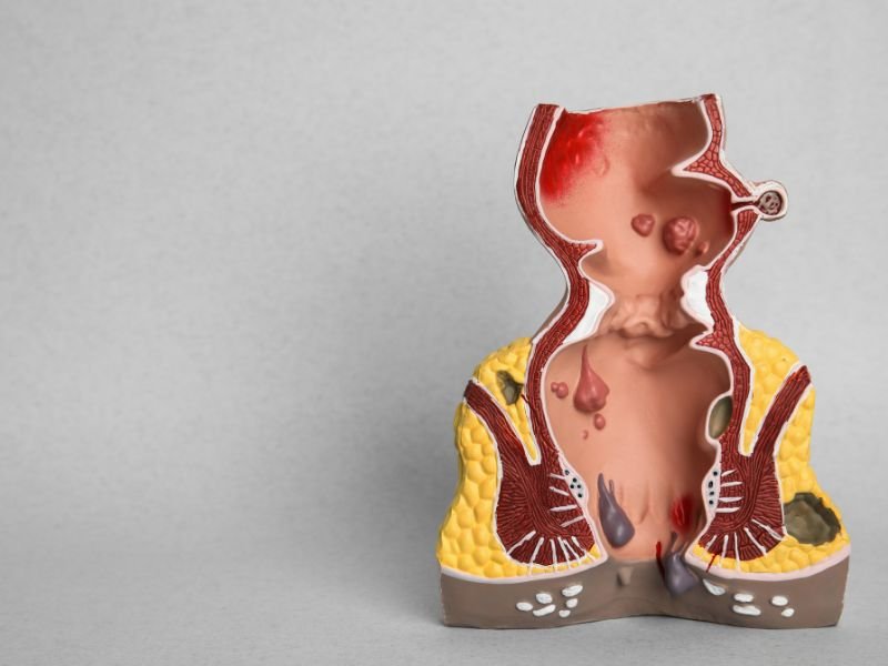 Medico para hemorroidas Porto Alegre