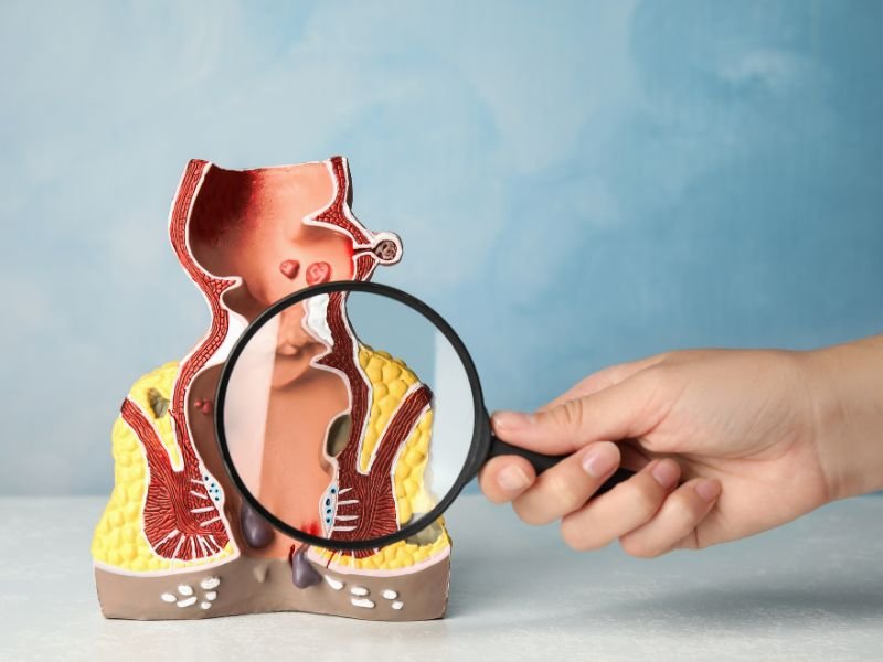 Melhor tratamento para hemorroidas Porto Alegre