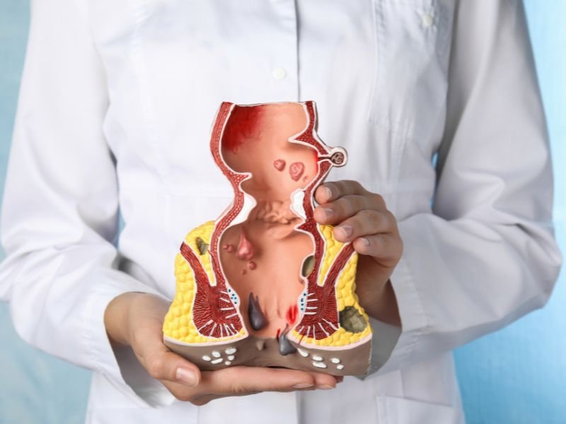 Tratamento rapido para hemorroidas Porto Alegre