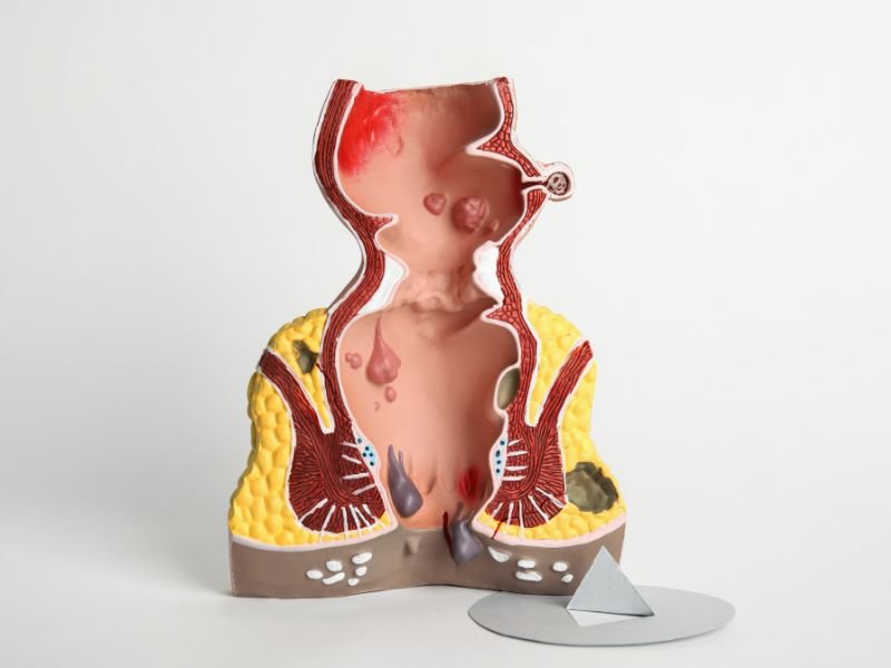 Tratamento sem dor hemorroidas Porto Alegre